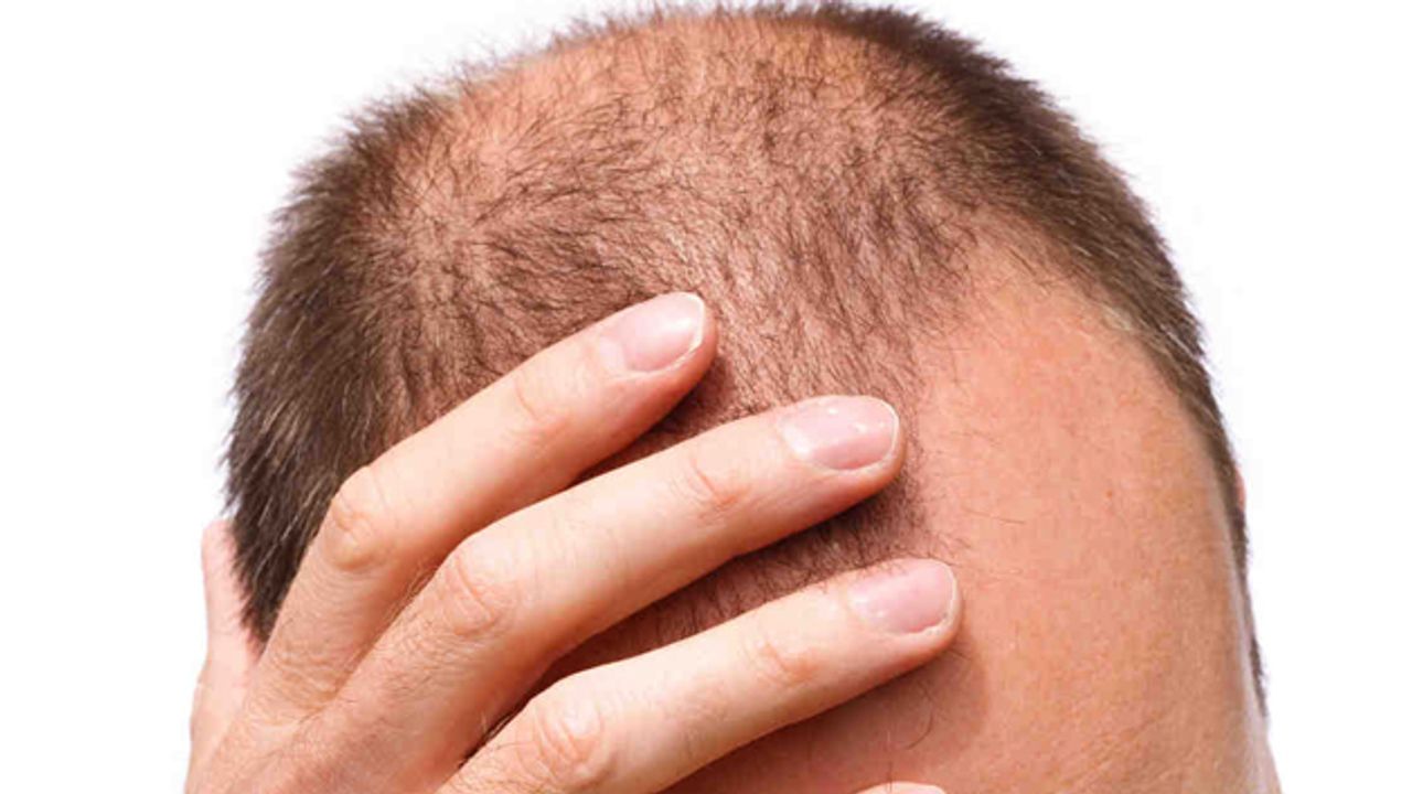 Saç Dökülmesine Karşı Hangi Önlemler Alınmalı?
