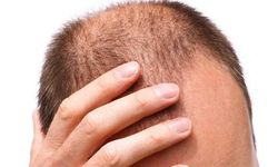 Saç Dökülmesine Karşı Hangi Önlemler Alınmalı?
