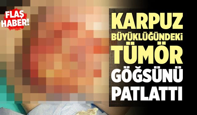 Karpuz Büyüklüğündeki Tümör Göğsünü Patlattı