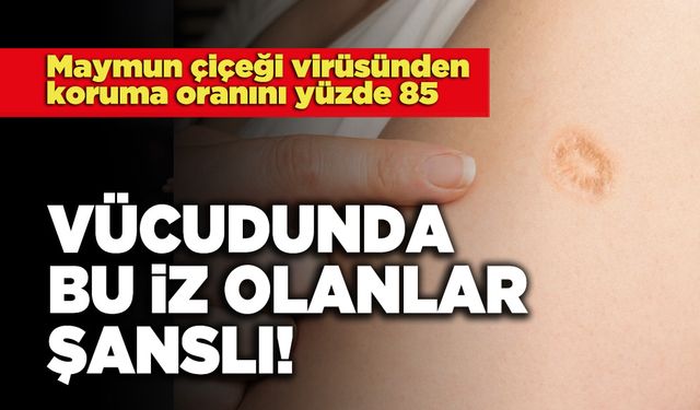 Vücudunda Bu İz Olanlar Şanslı!