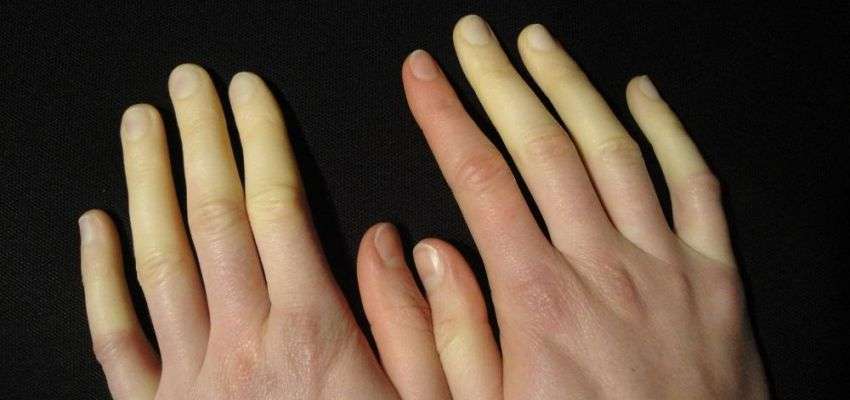 raynaud-fenomeni-image-850x400-crop